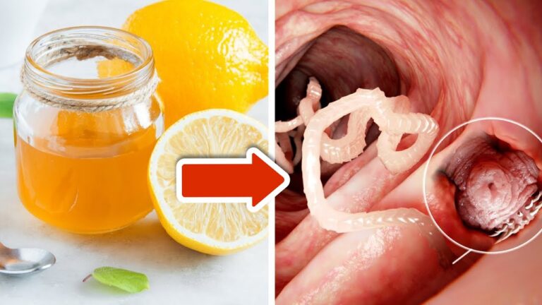 Scopri 5 modi efficaci per eliminare i vermi intestinali con limone e miele!
