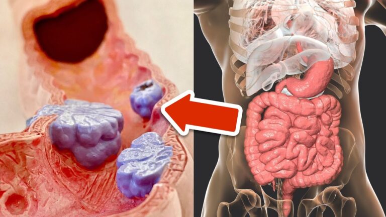 Riduci il rischio di cancro al colon: 6 strategie efficaci da conoscere!