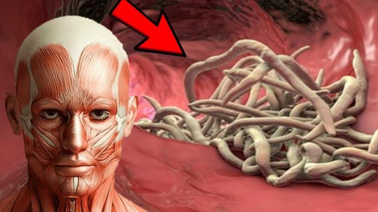 7 segnali che indicano la presenza di parassiti nel tuo corpo da non sottovalutare