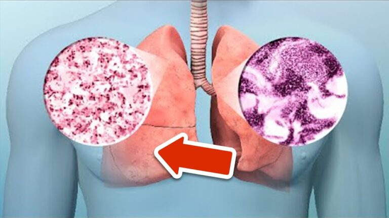 8 segnali di allerta sul cancro ai polmoni che devi conoscere ora!