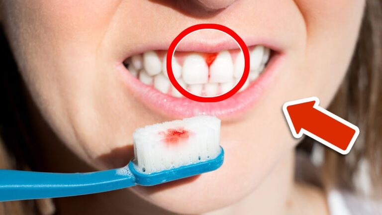7 motivi sorprendenti per cui hai gengive sanguinanti e come risolverli!