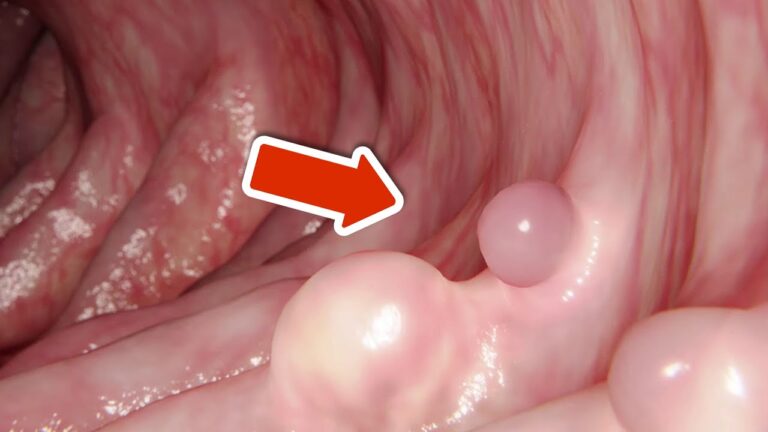 8 segnali di allerta del cancro intestinale da non ignorare assolutamente!