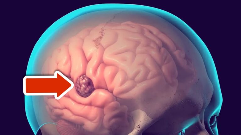 Scopri 6 segnali di allerta per il tumore al cervello da non ignorare!