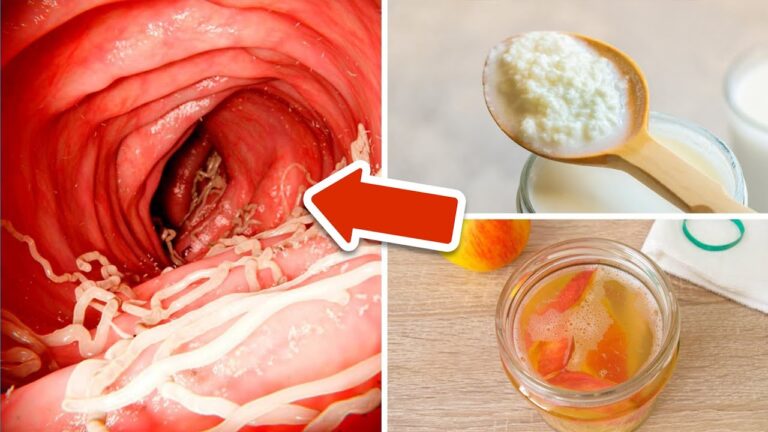4 alimenti naturali contro i vermi intestinali da provare subito!